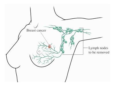 breast cancer in lymph node removal Breast cancer in lymph node removal